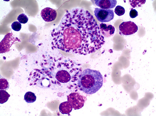 Clinical Case-Pancytopenia