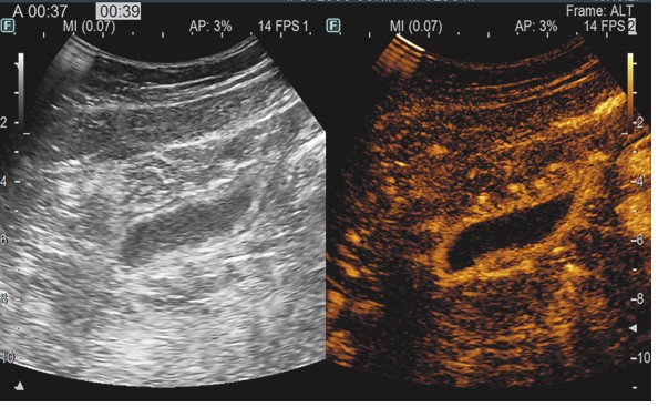 Picture 3. CEUS evaluation: small bowel wall inflammation and lumen distension; additional colon wall inflammation and lumen distension