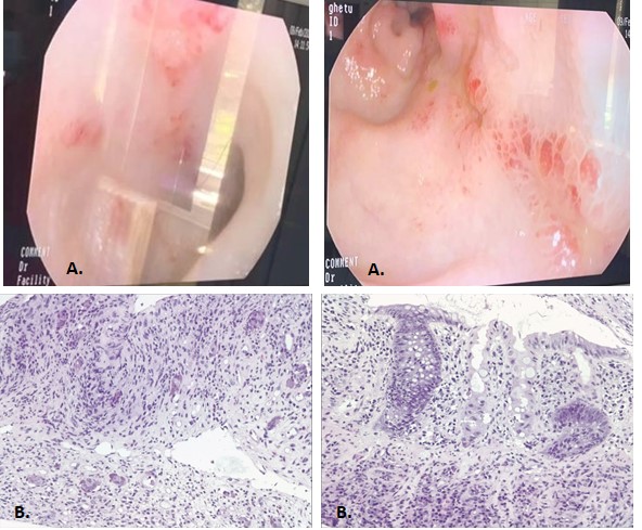 Picture 4. A. Endoscopic aspect of intestinal wall with edema, hiperemia, ulceration and purulent exsudate. B. Histopathological examination: mucosal ulceration, granulation tissue, glandular