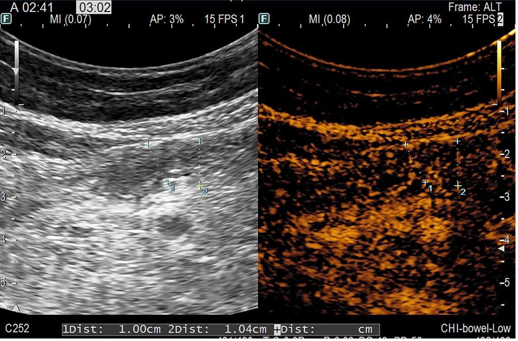 Picture 5. CEUS evaluation after FMT: normal bowel wall thickness and lumen diameter